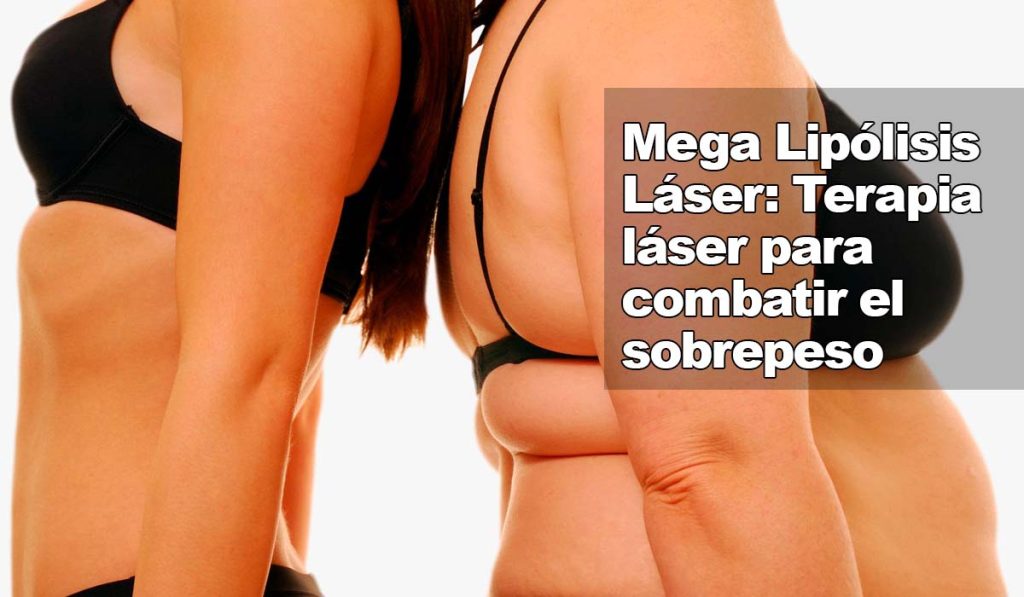Conoce la terapia láser para eliminar grasa: Mega Lipólisis Láser